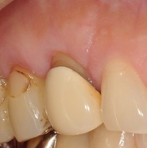 歯ぐきの再生治療・CASE2