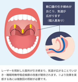 軟口蓋の引き締め