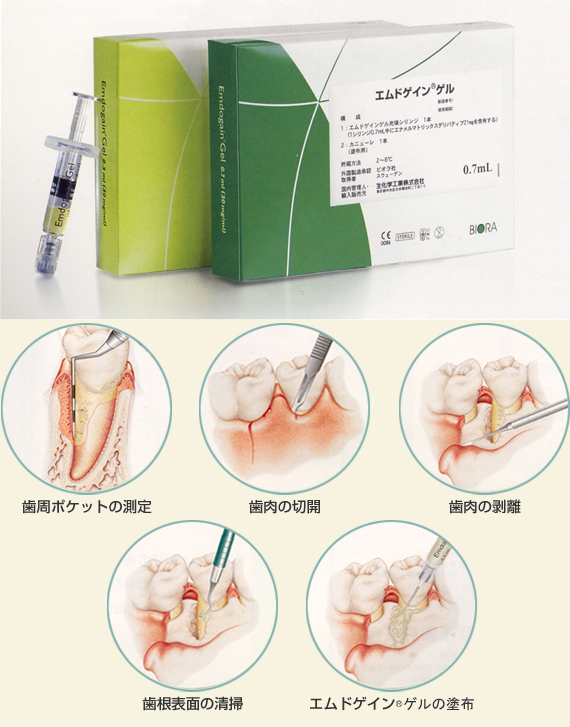 4．骨の再生治療（エムドゲイン）