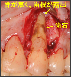 4.骨の再生治療(エムドゲイン)