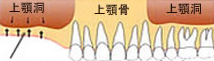 骨の再生治療(上顎洞底挙上術)