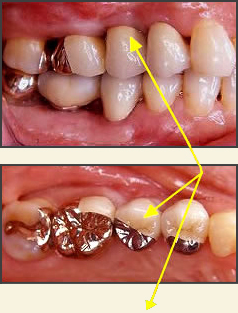 ①歯槽頂アプローチ法による手術