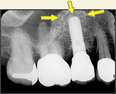 ①歯槽頂アプローチ法による手術