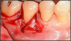 歯ぐきの再生治療・CASE1