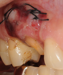 歯ぐきの再生治療・CASE2