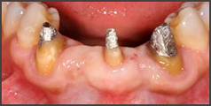 歯ぐきの再生治療・CASE3
