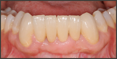 歯ぐきの再生治療・CASE3