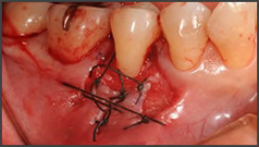 歯ぐきの再生治療・CASE1