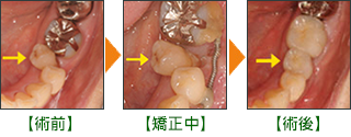 矯正治療 CASE1