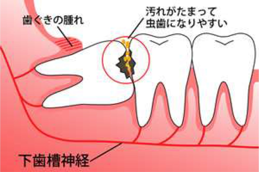 ≪親知らずの生えている方向に注意！≫