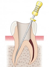 根管治療