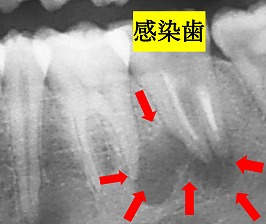 根管治療 CASE