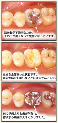 虫歯の治療について