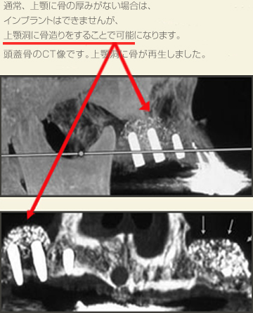 骨の再生治療について