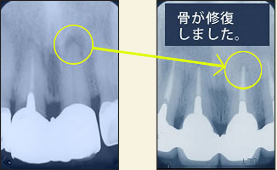 当院の歯の保存のこだわり