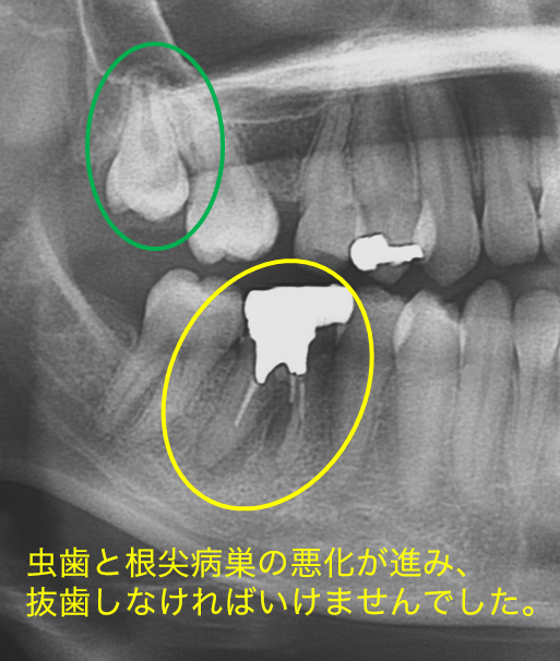 歯の移植