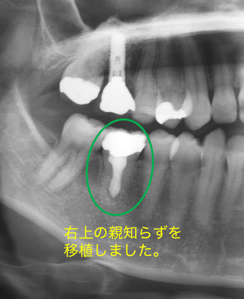 歯の移植